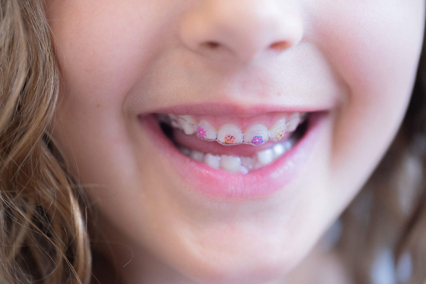 invisalign first za djecu ortodontska terapija