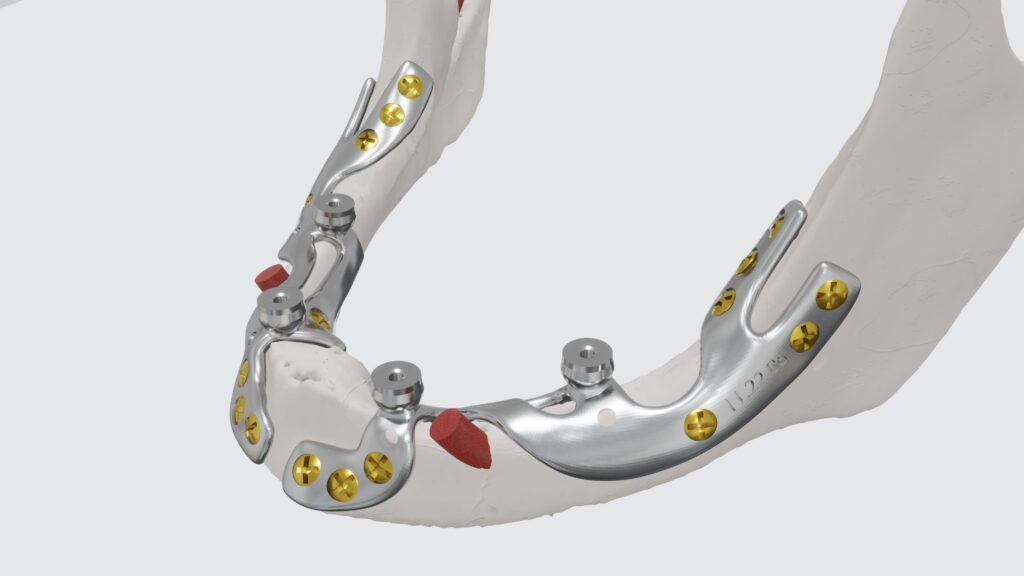 Subperiostalni implantati - fiksni zubi bez kosti