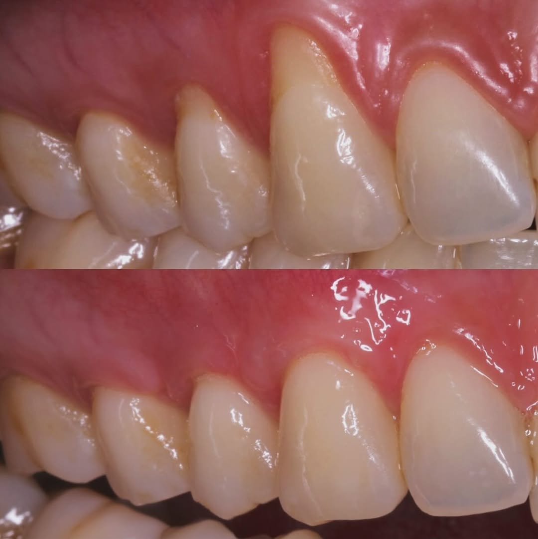 Prije i poslije: prekrivanje recesije desni – parodontološka terapija u Orto Nova Rijeka