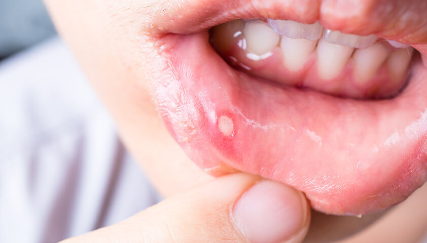 Язвы во рту